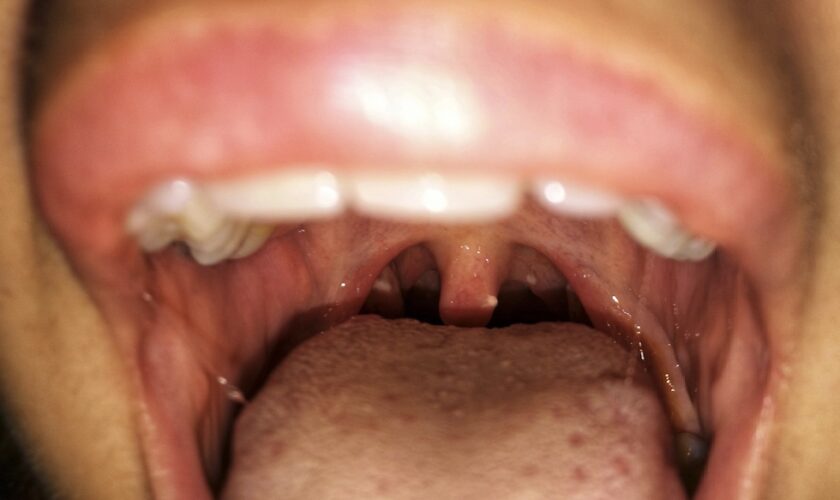 Public Health Wales: Awareness of mouth cancer symptoms could save lives